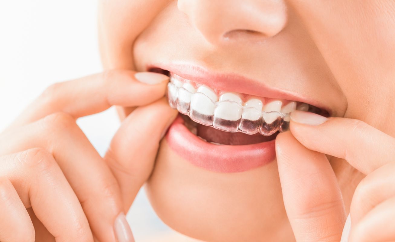 How to Take Care of Your Retainer